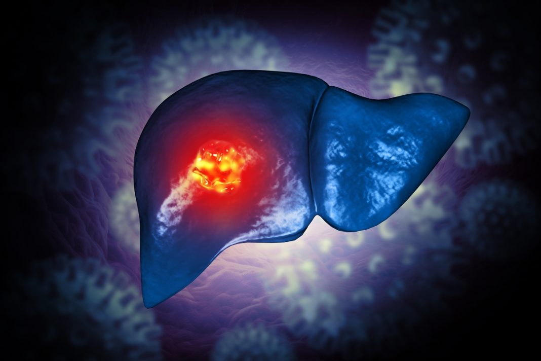 cancer-de-figado:-mudanca-de-habitos-pode-prevenir-ate-60%-dos-casos