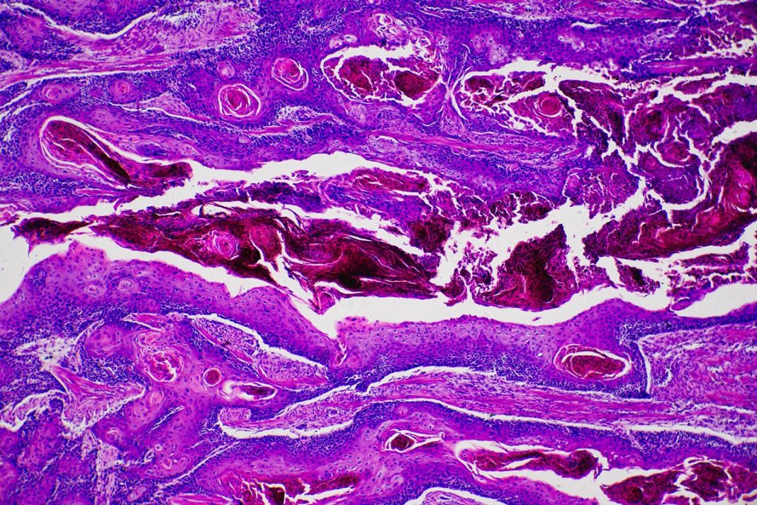 oncologista-lista-principais-sintomas-do-cancer-de-pele-nao-melanoma