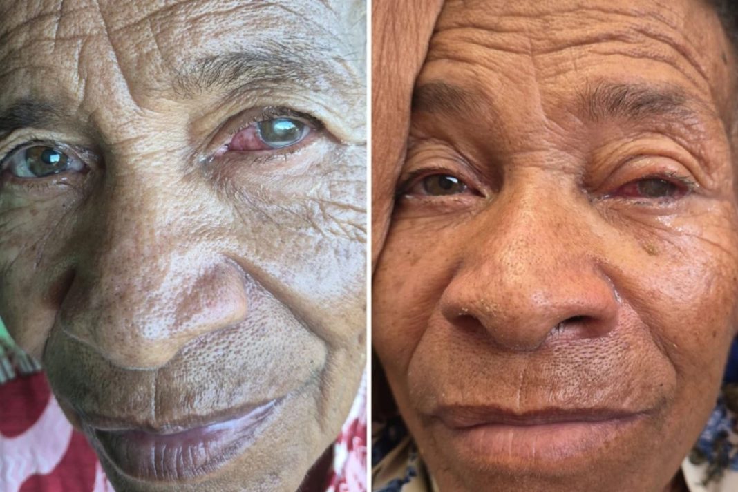 mulher-de-79-anos-perde-a-visao-de-um-olho-apos-mutirao-ofalmologico