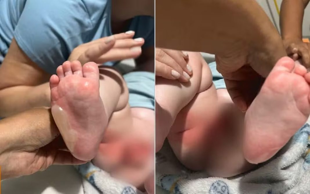 go:-bebe-fica-ferido-apos-ser-queimado-durante-banho-em-bercario