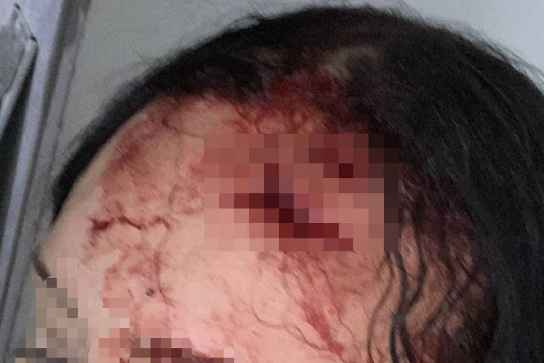 apos-levar-fora,-homem-rasga-cabeca-de-mulher-com-garrafa-no-df.-veja-video