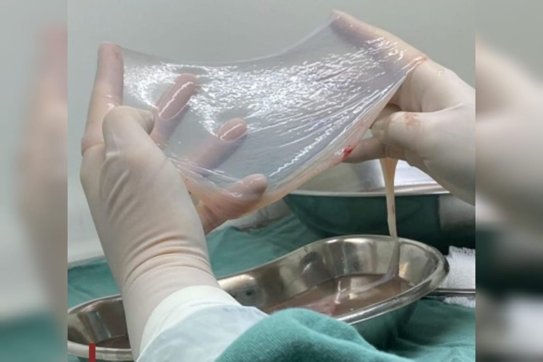 sus-amplia-uso-de-tecido-amniotico-para-tratar-pacientes-com-diabetes