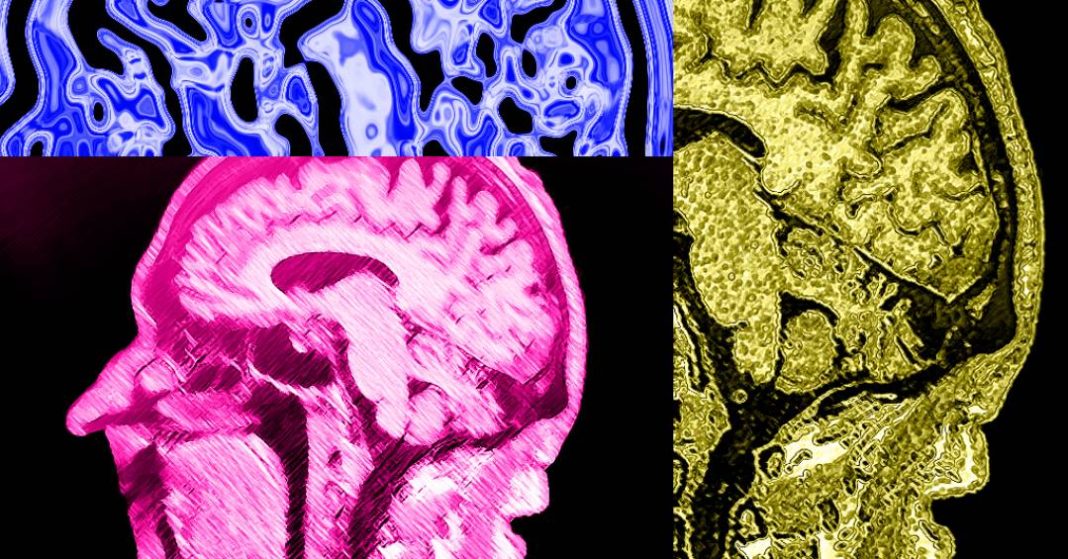 revisao-de-estudos-diz-que-classe-de-medicamentos-contra-o-alzheimer-tem-pouca-eficacia