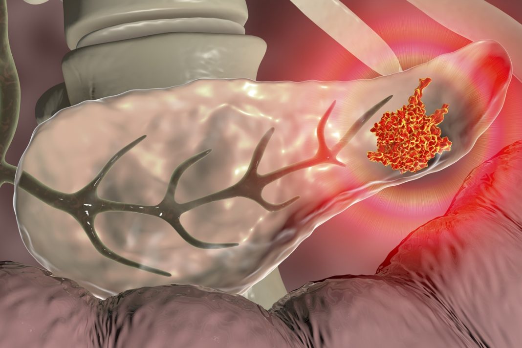 manual-explica-por-que-cancer-de-pancreas-e-desafiador