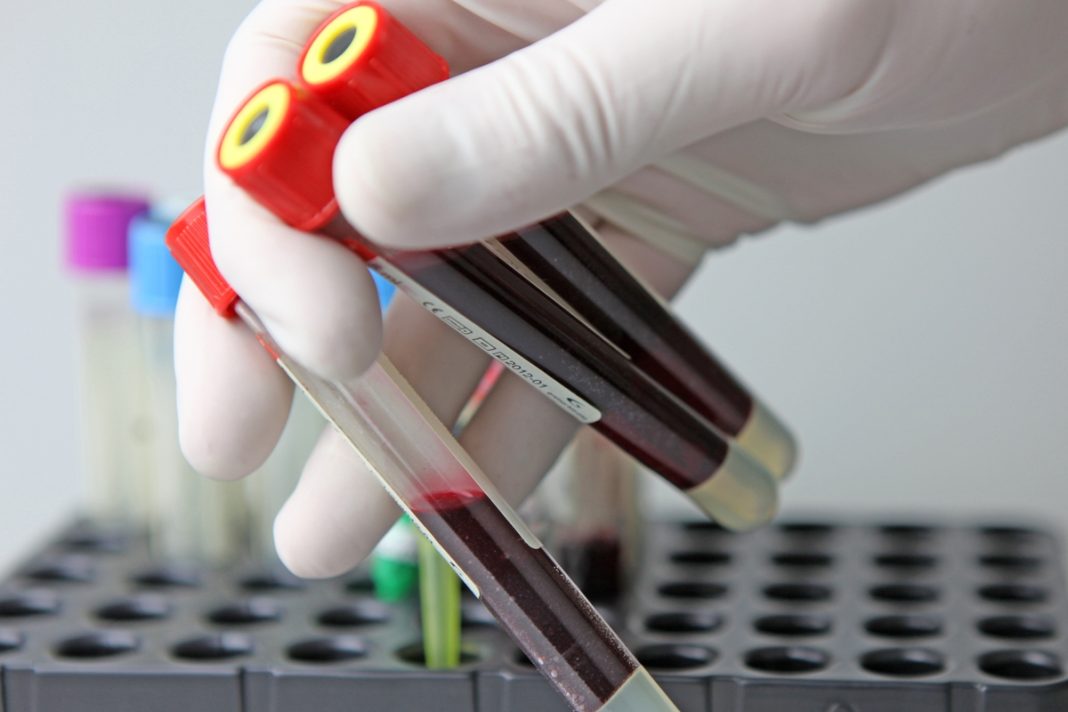 estudo-aponta-alteracao-no-sangue-como-possivel-sinal-de-depressao