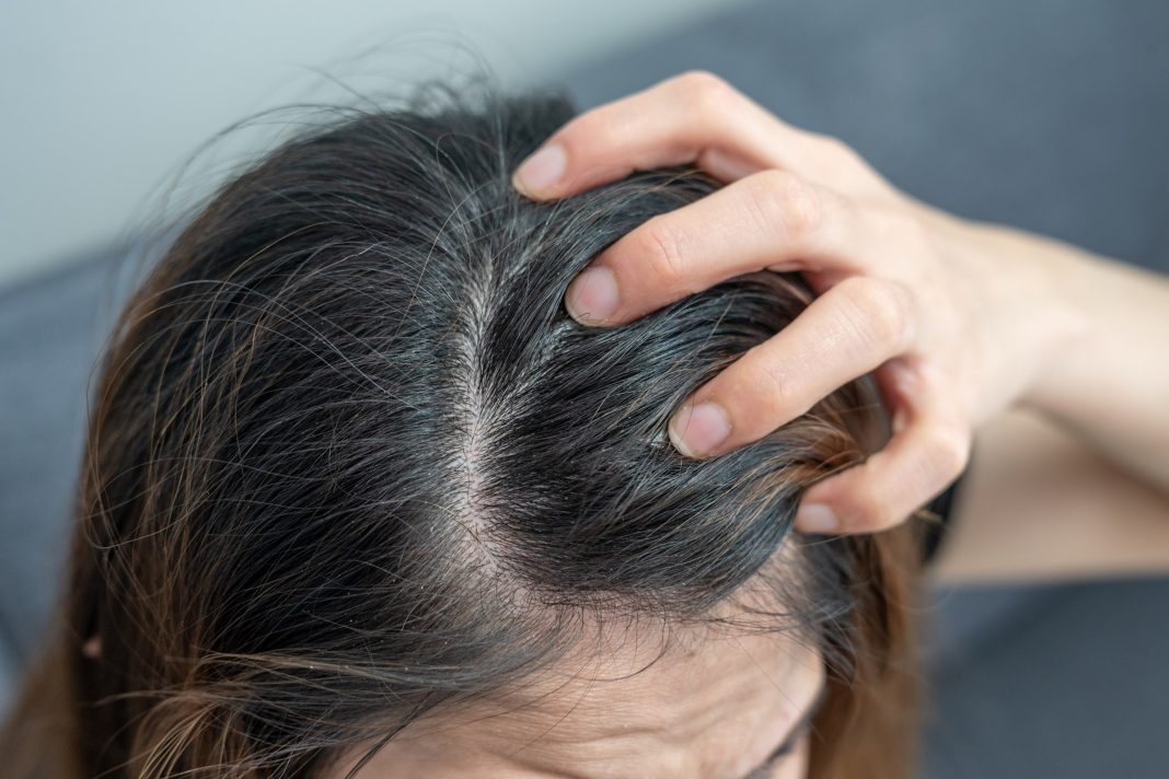 tomar-sol-no-cabelo-ajuda-a-diminuir-a-caspa?-entenda-se-efeito-existe