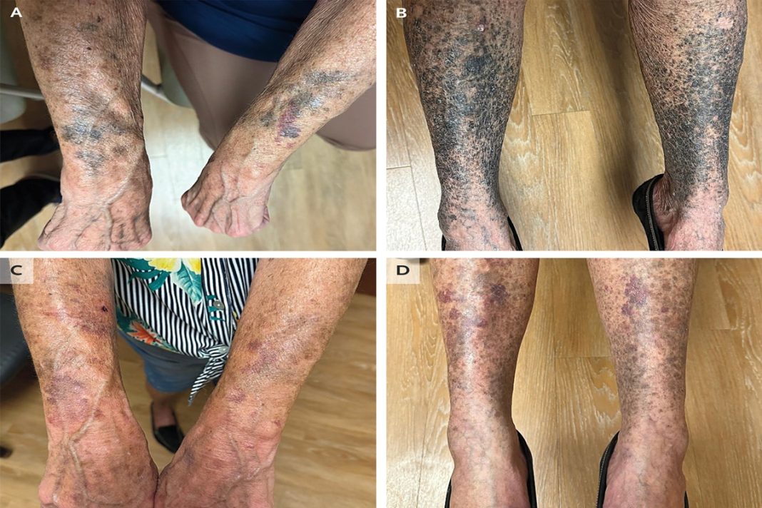raro:-pele-de-mulher-escurece-apos-uso-de-antibiotico-para-rosacea