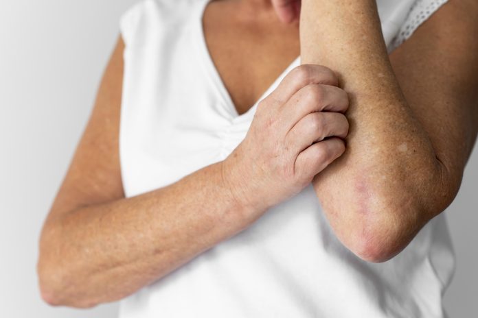 novos-estudos-revelam-mecanismos-do-lupus,-mas-cura-continua-distante