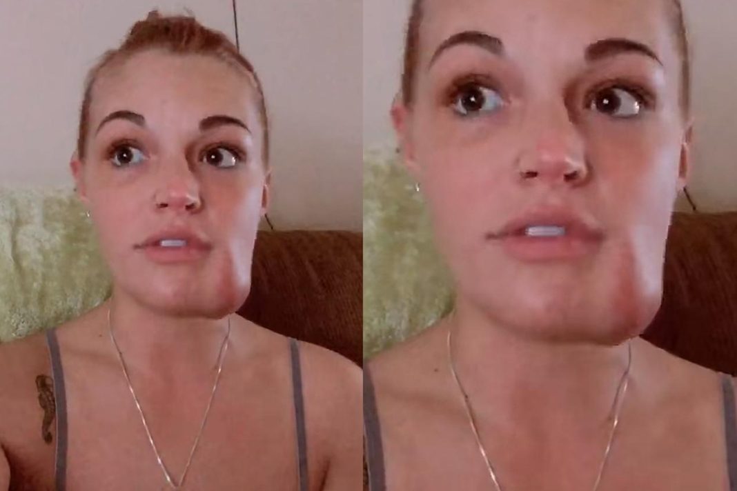mulher-tenta-espremer-“espinha”-e-descobre-tumor-vascular-no-rosto
