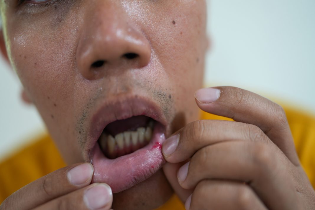 cuidado-bucal-e-dieta-ajudam-a-aliviar-inflamacoes-da-quimioterapia