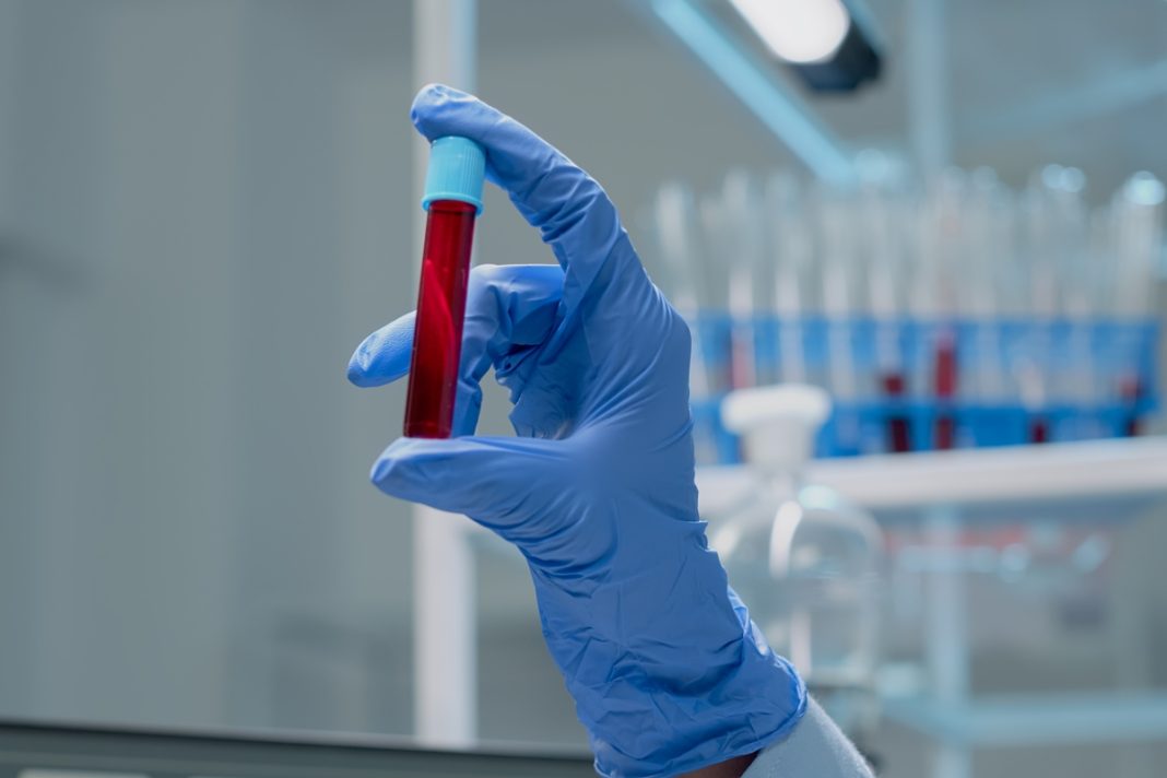 novo-exame-de-sangue-que-detecta-mais-de-50-tipos-de-cancer-chega-ao-brasil