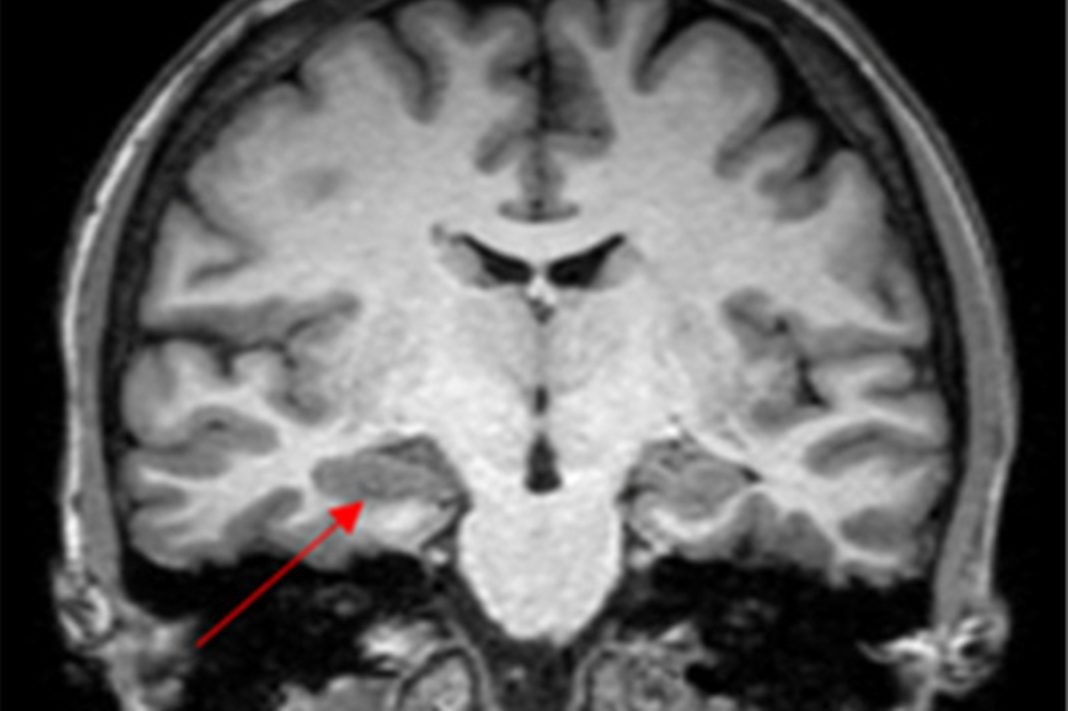 caso-de-convulsao-na-menstruacao-levanta-suspeita-de-endometriose-cerebral